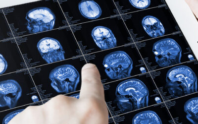 Understanding Signs and Symptoms of Brain Tumors – Insight Neurosurgery